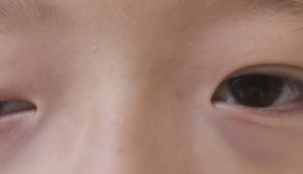 孩子上睑下垂什么时候做手术好？别错过这个黄金时期